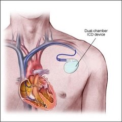 Имплантируемый кардиовертер-дефибриллятор 