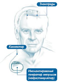 Стимуляция глубинных структур мозга (DBS) операция лечение эпилепсии
