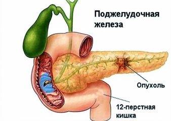 Рак поджелудочной железы – первые признаки и симптомы, причины, диагностика и лечение в Москве