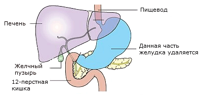операция по удалению желудка