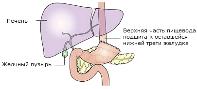 Методы лечения рака желудка в Израиле