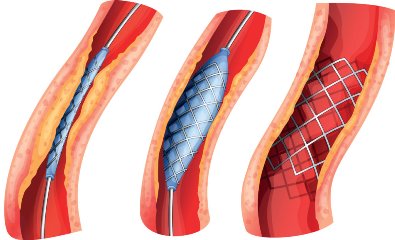 Стентирование артерий нижних конечностей противопоказания