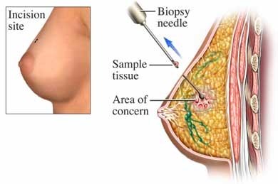 биопсия молочный железы