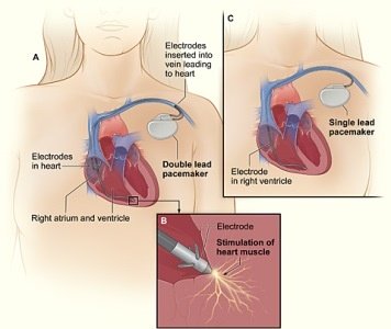 Электрокардиостимулятор сердца