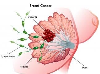 Лечение рака груди в Израиле