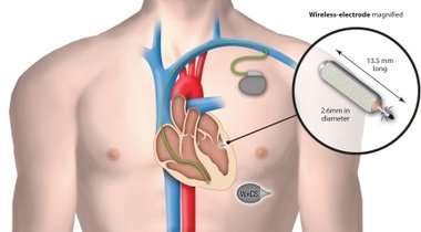 Отзывы пациентов о кардиостимуляторе сердца